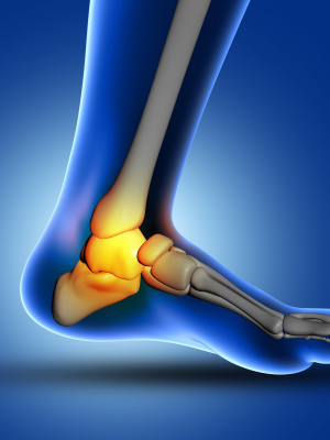 Halluks Valgus